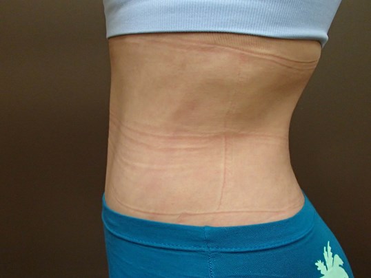 Liposuction After