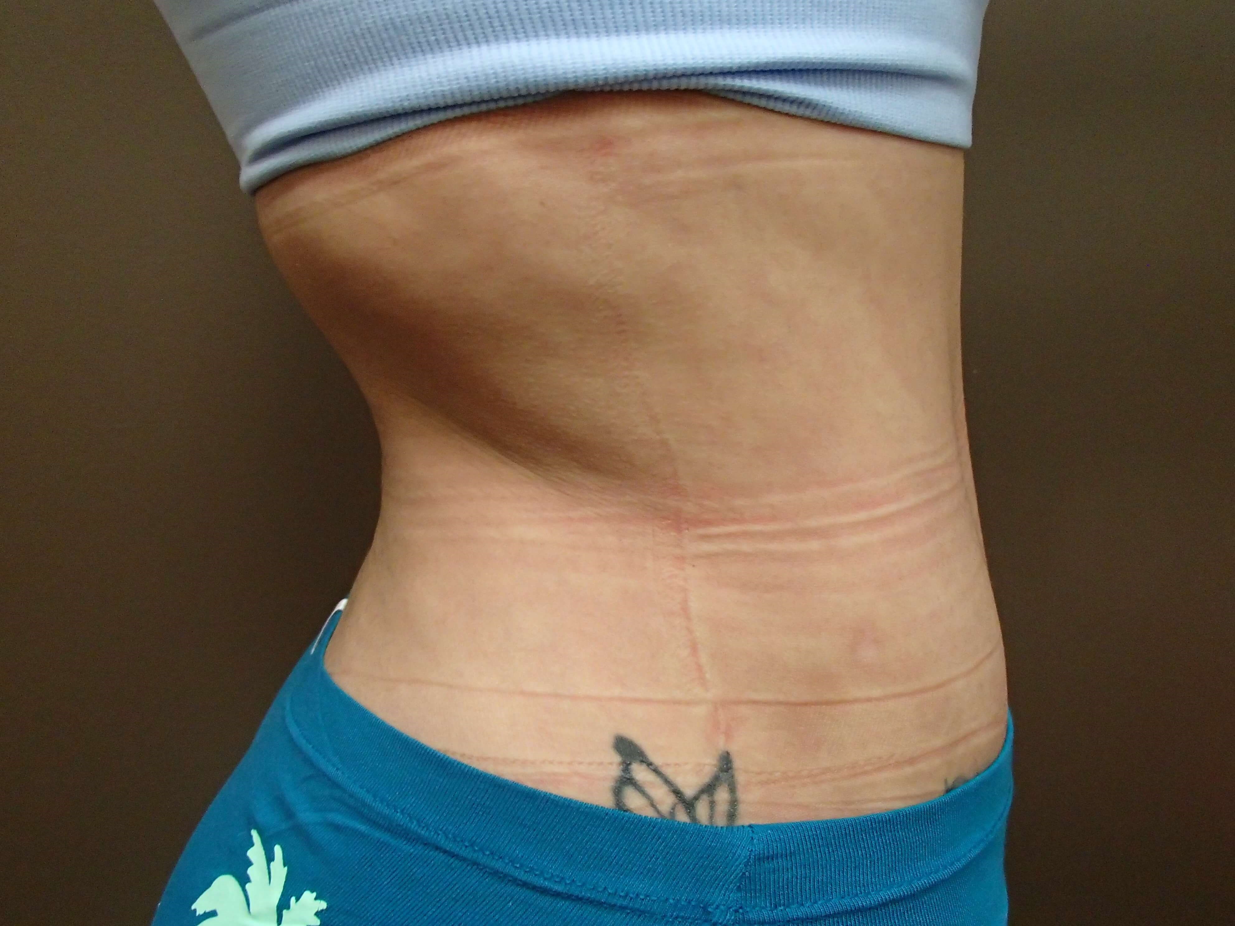 Liposuction After