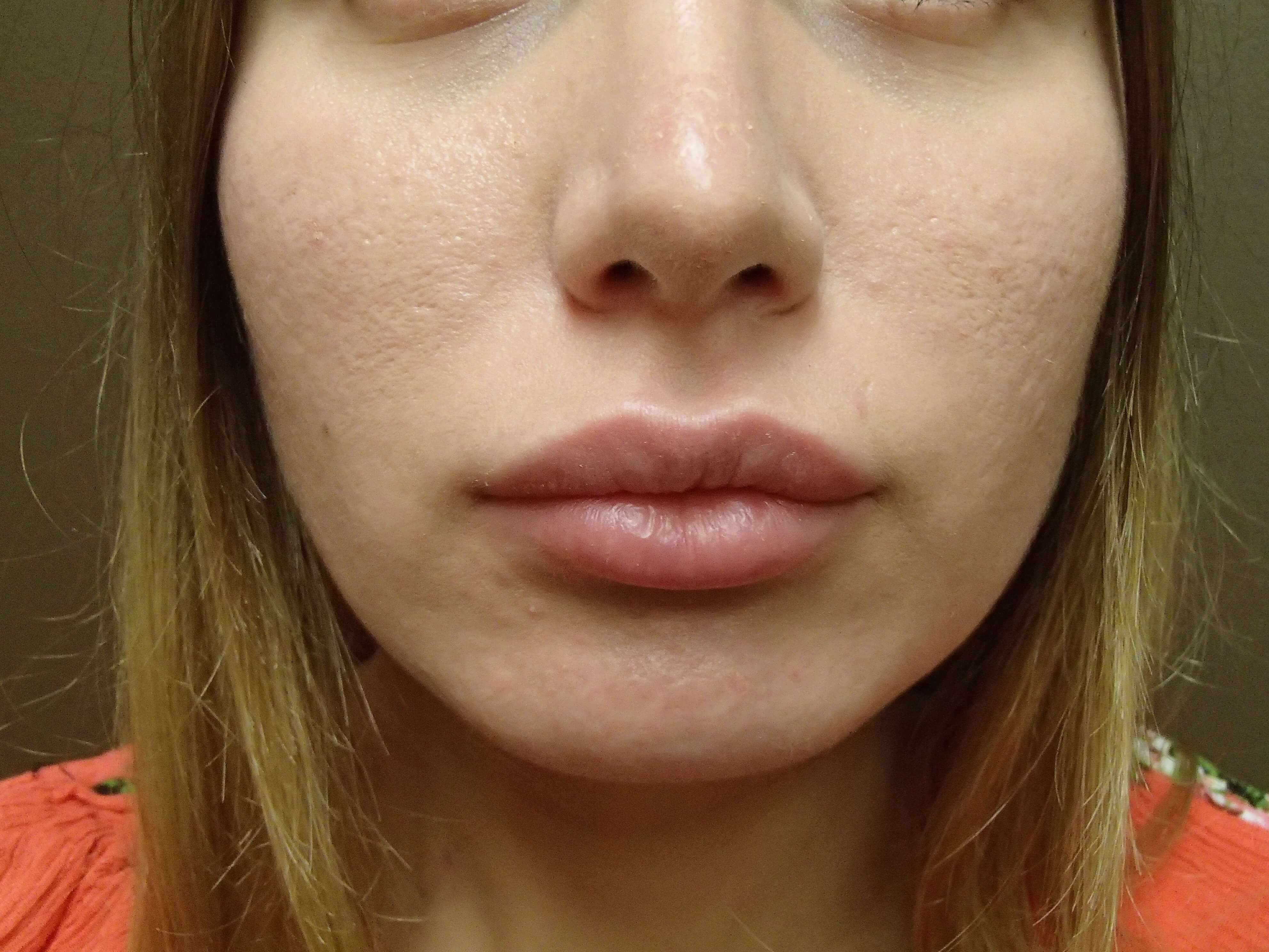 Buccal Fat Pad Removal After