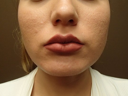 Buccal Fat Pad Removal Before