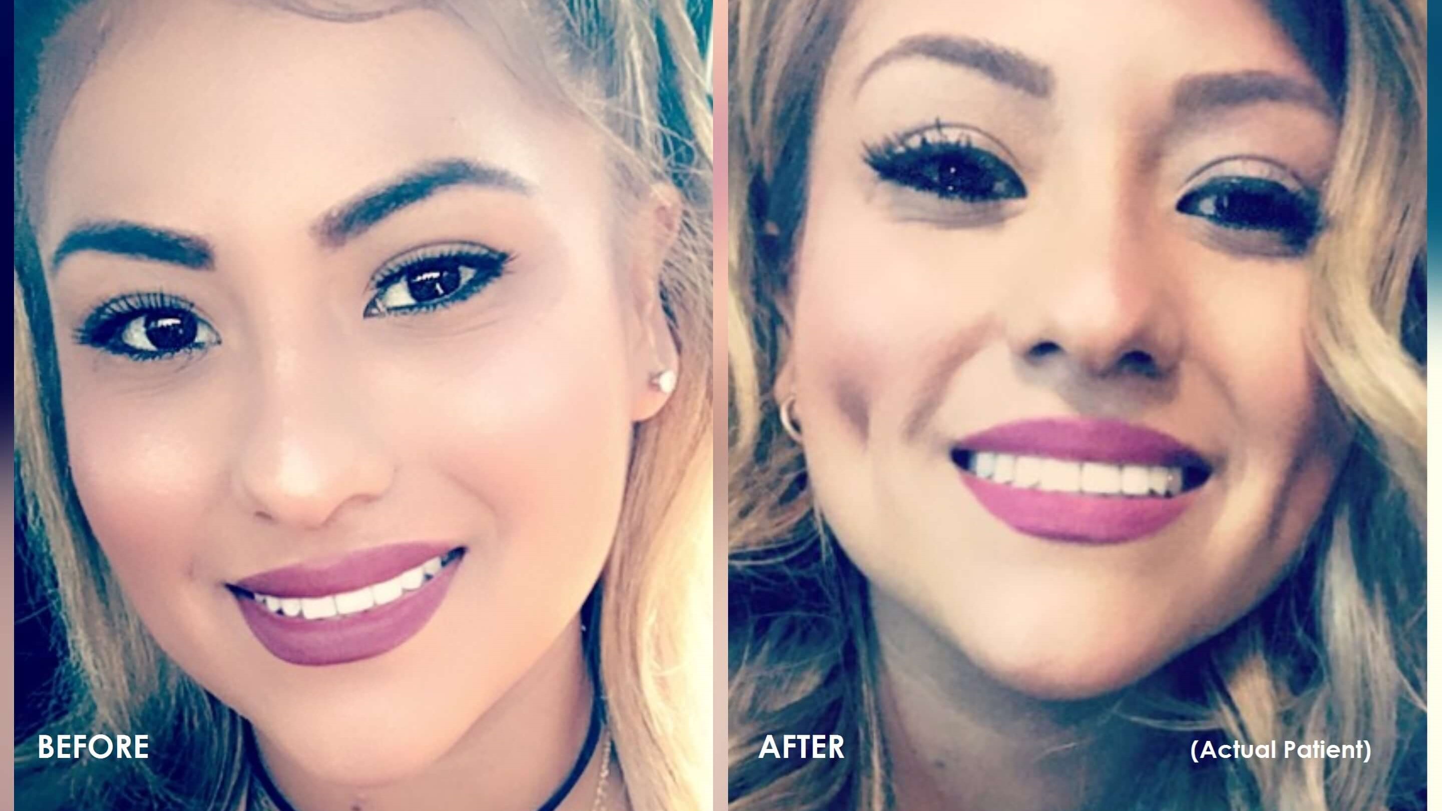 Dimple Shots Is Dimpleplasty Worth It? The Timeless Dimple Definitely Is!