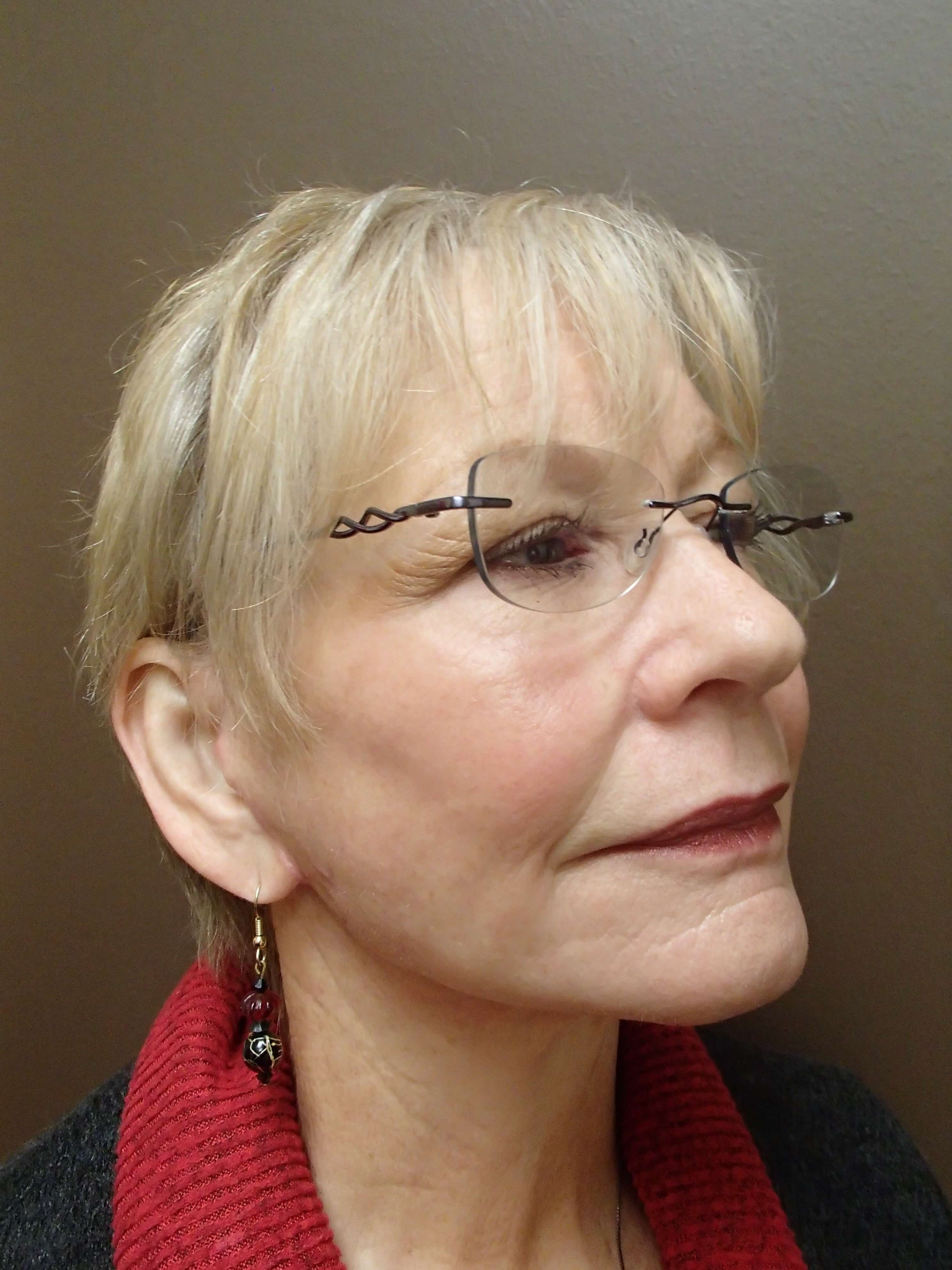 Facelift/Necklift After