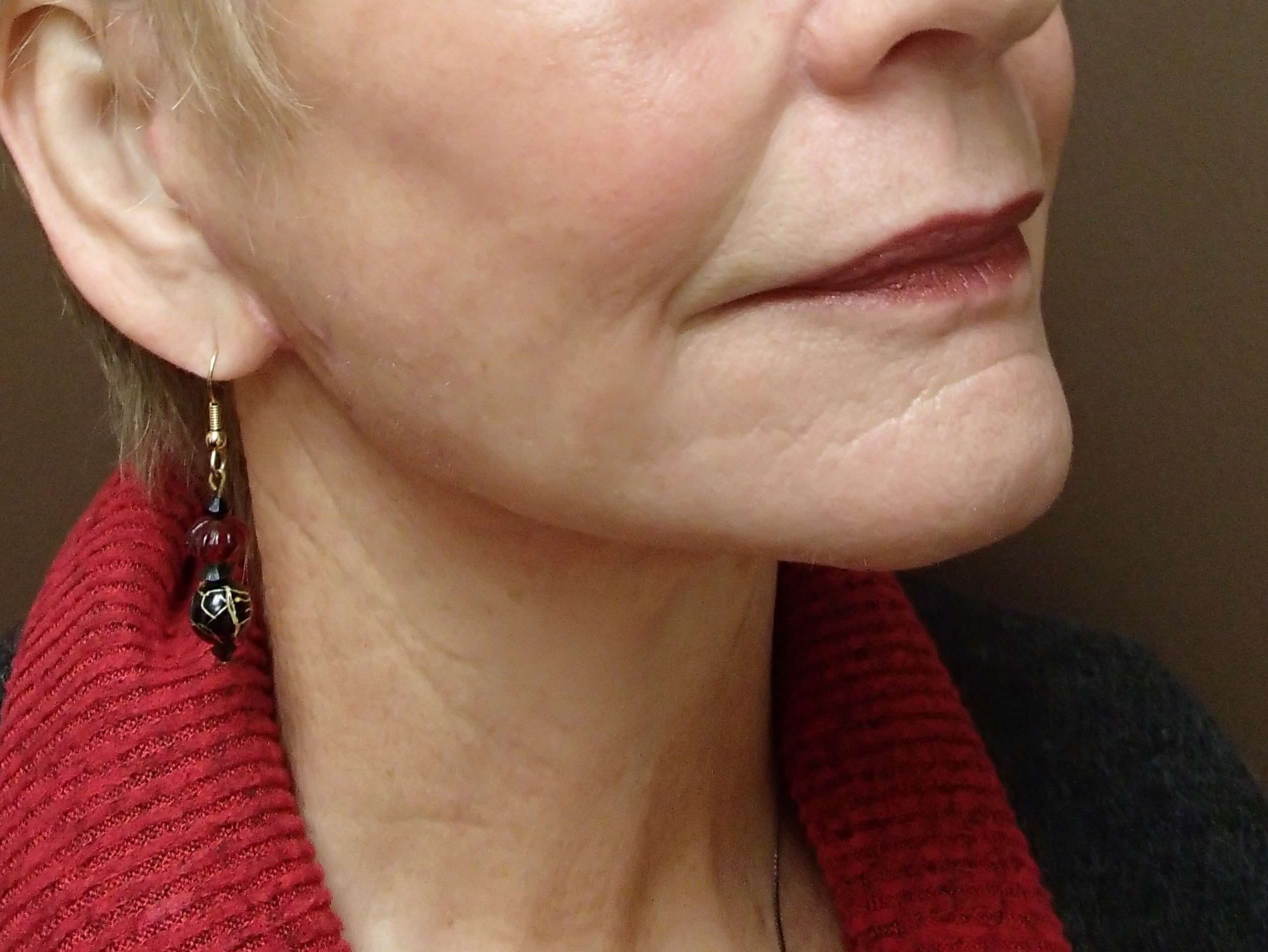 Facelift/Necklift After