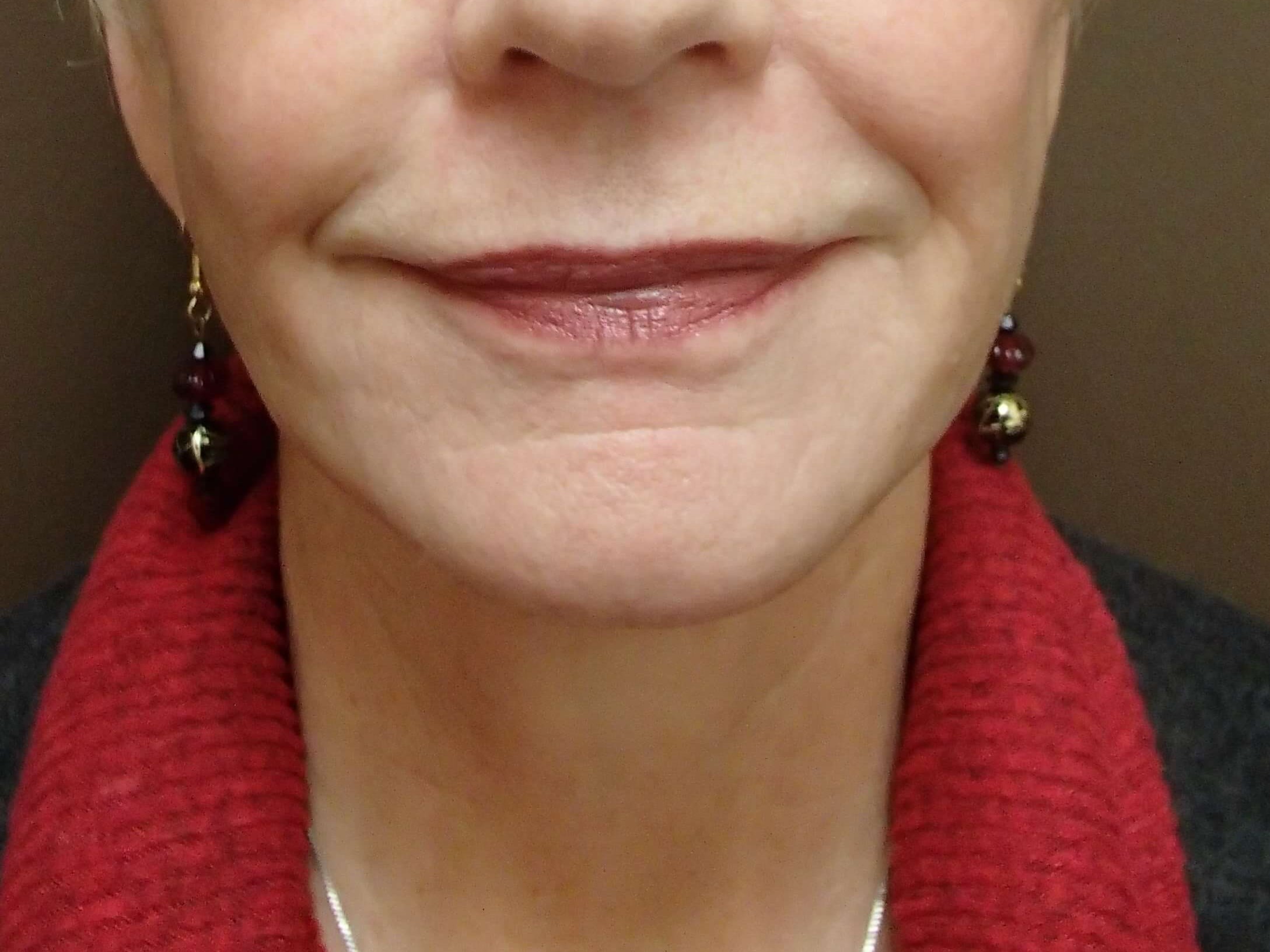 Facelift/Necklift After