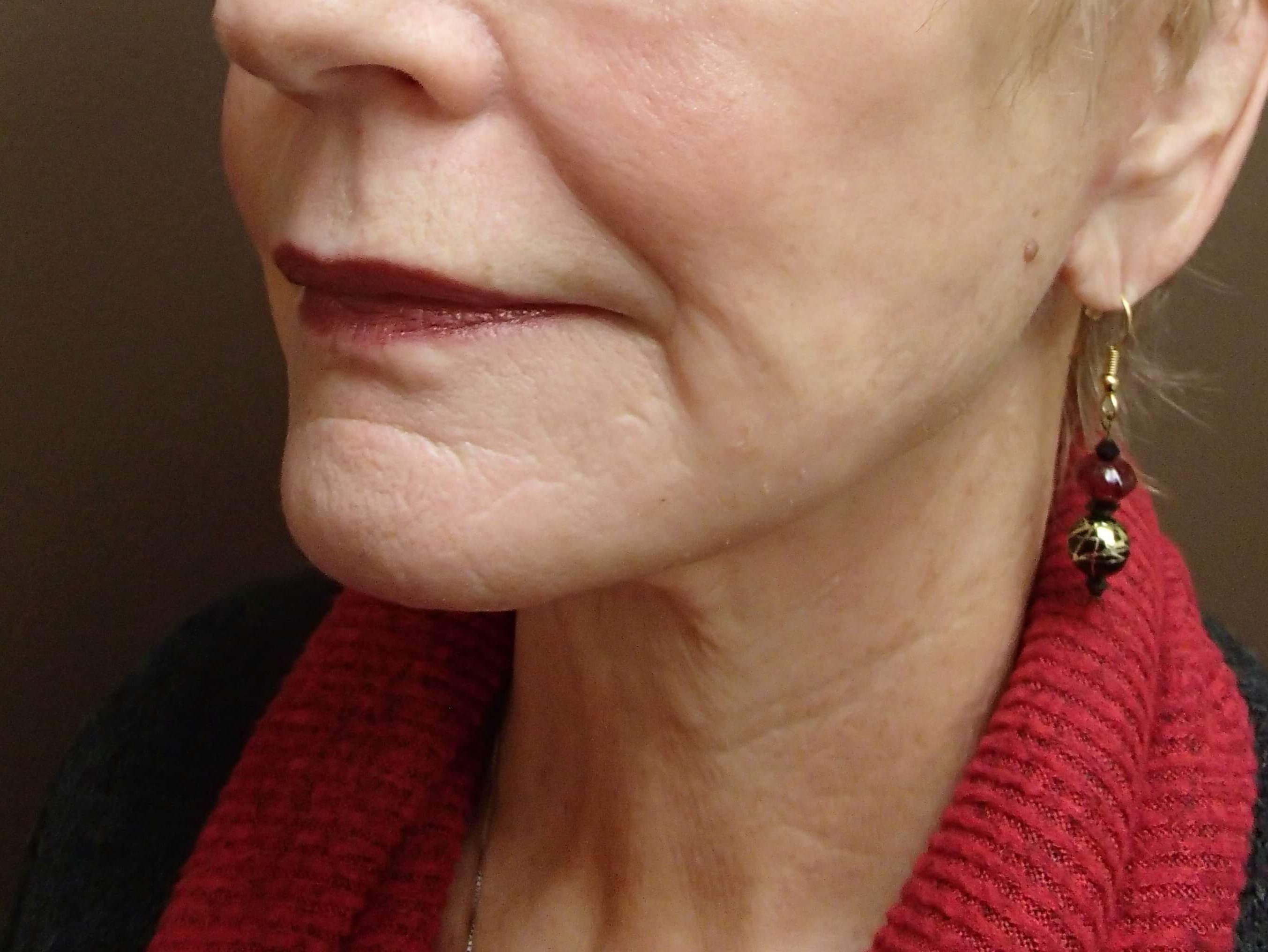 Faclift/Necklift After