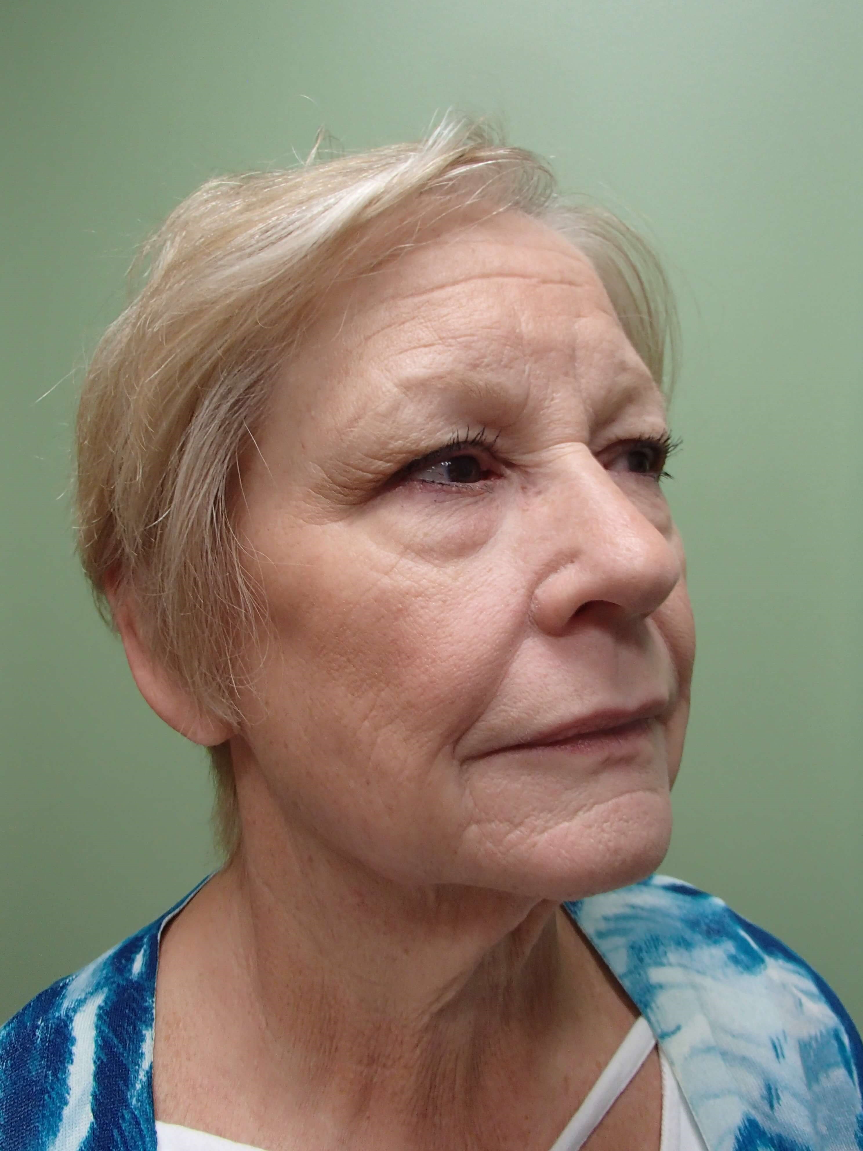 Facelift/Necklift Before