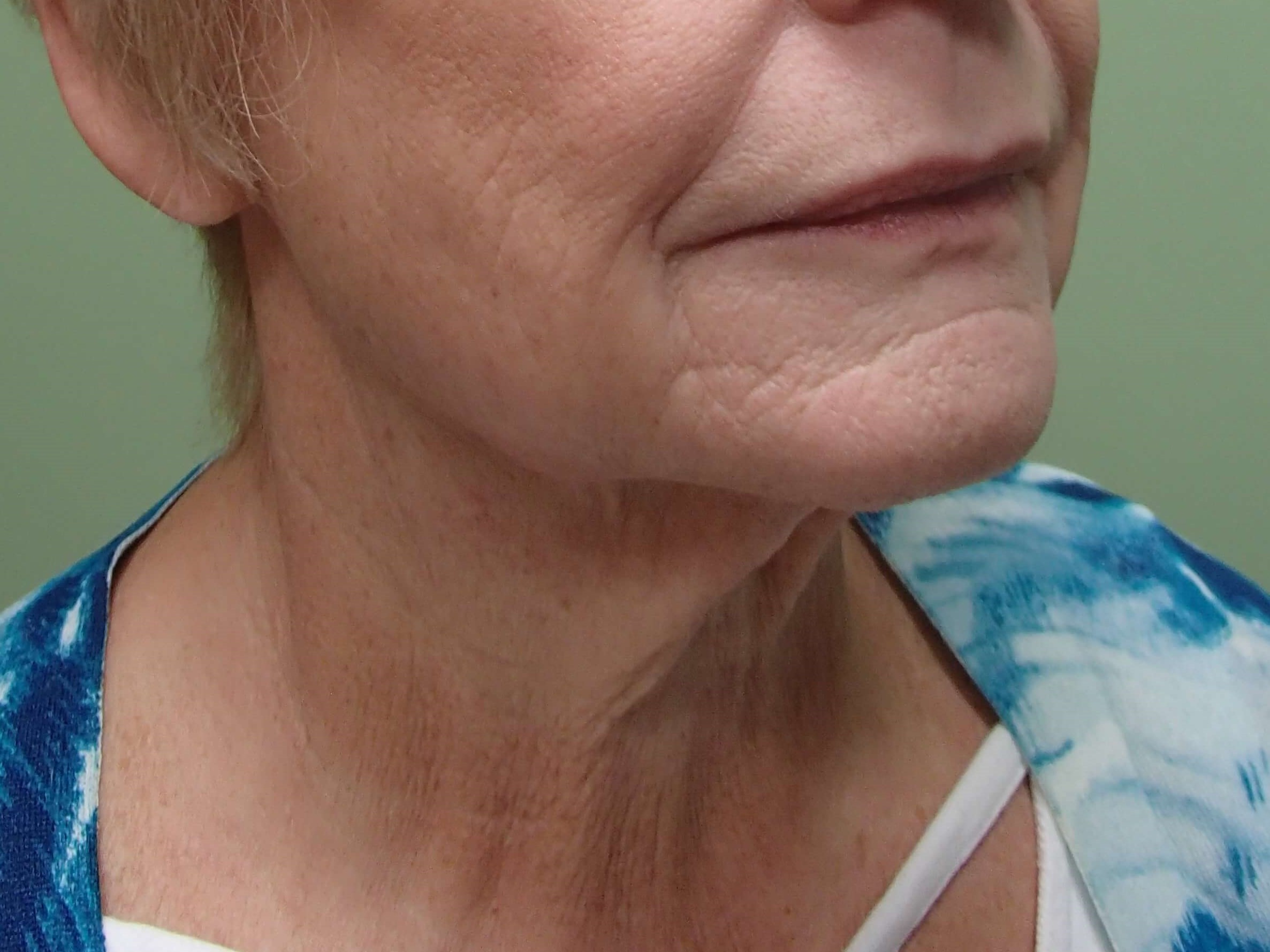 Facelift/Necklift Before
