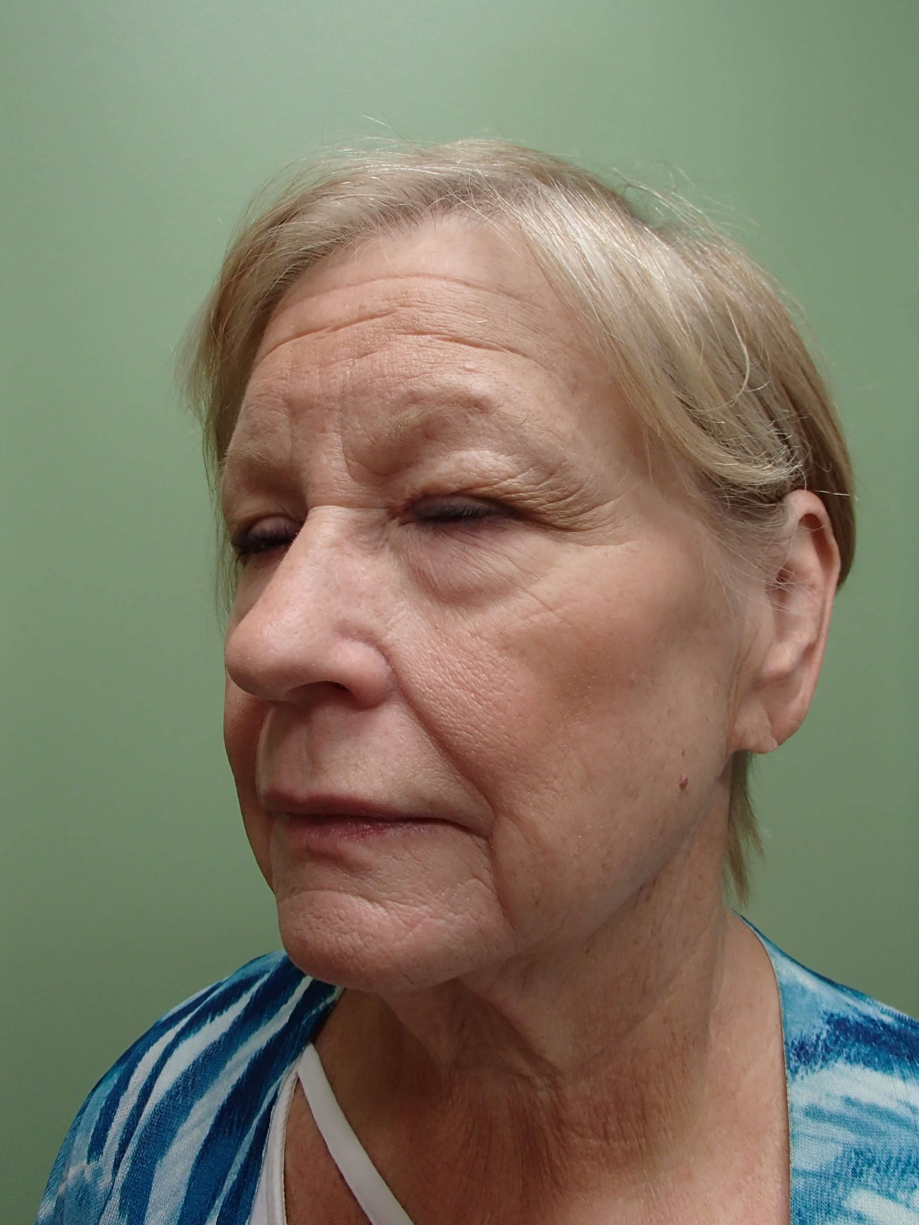 Faclift/Necklift Before