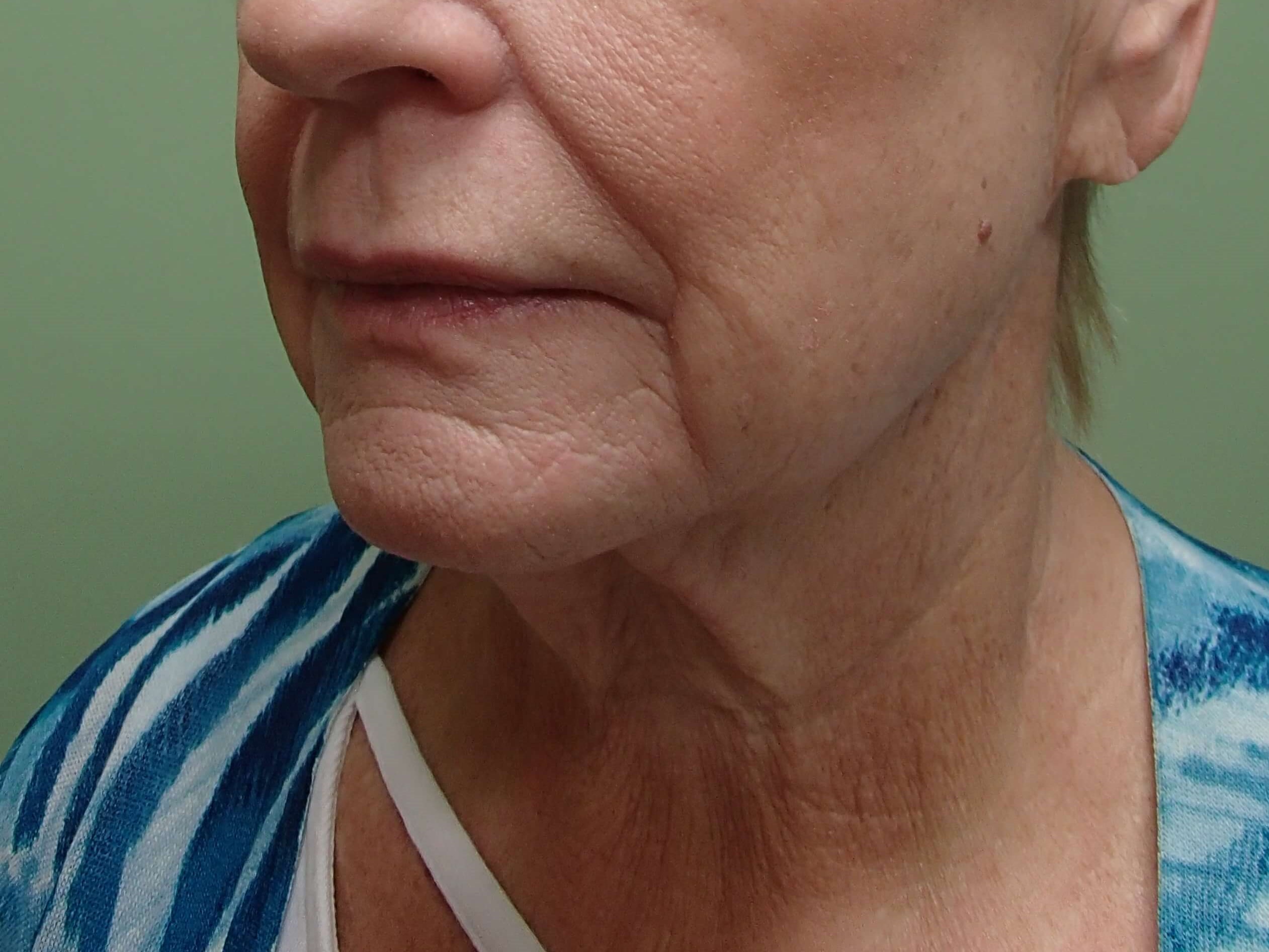Faclift/Necklift Before