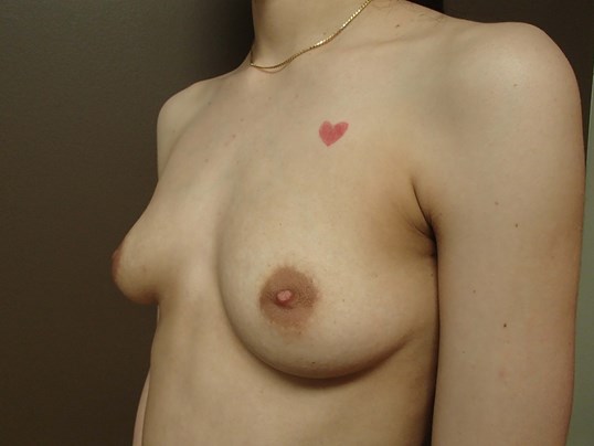 Breast Augmentation Before