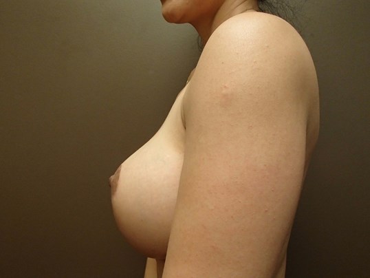 Breast Lift with Implants After