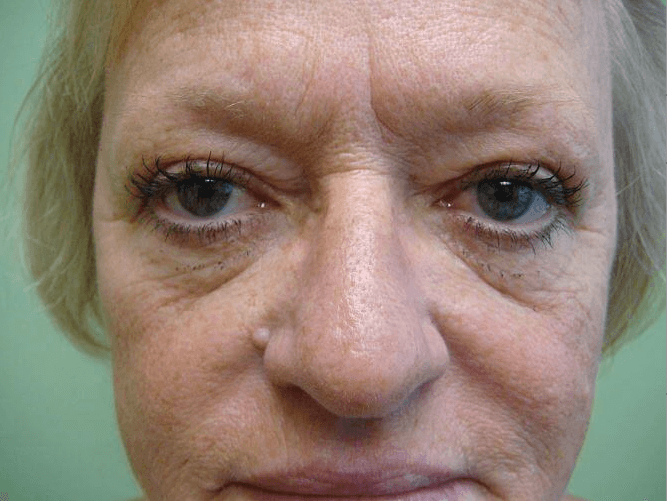 Blepharoplasty Before