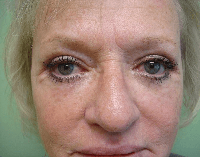 Blepharoplasty After