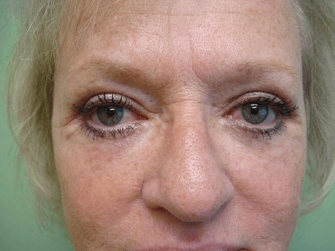 Blepharoplasty After
