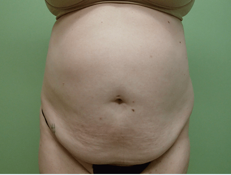 Abdominoplasty and Liposuction Before