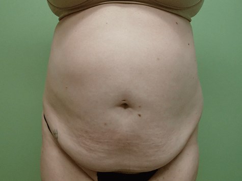 Abdominoplasty and Liposuction Before
