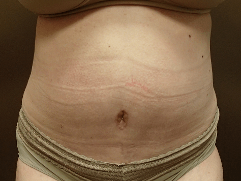 Abdominoplasty and Liposuction After