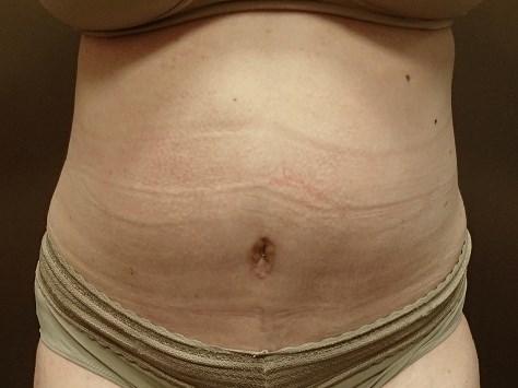 Abdominoplasty and Liposuction After