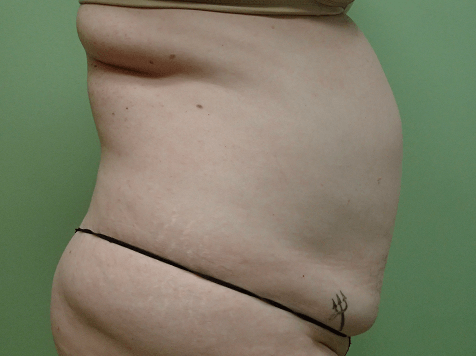 Abdominoplasty and Liposuction Before