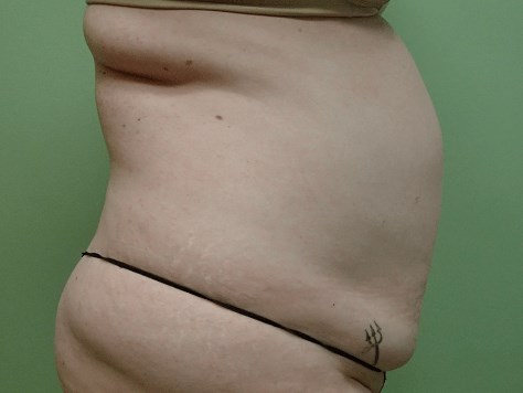 Abdominoplasty and Liposuction Before