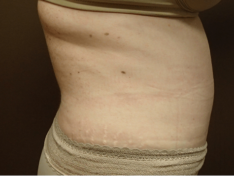 Abdominoplasty and Liposuction After