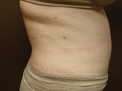Abdominoplasty and Liposuction After