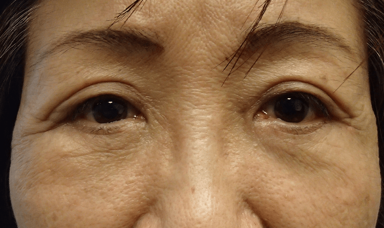 Blepharoplasty After