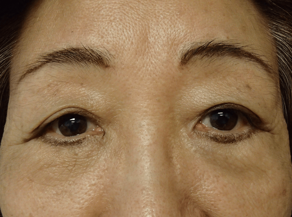 Blepharoplasty Before