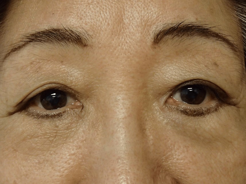 Blepharoplasty Before