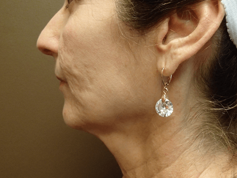 Facelift and Necklift Before