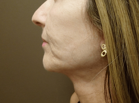 Facelift and Necklift After