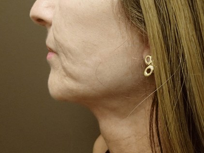 Facelift and Necklift After