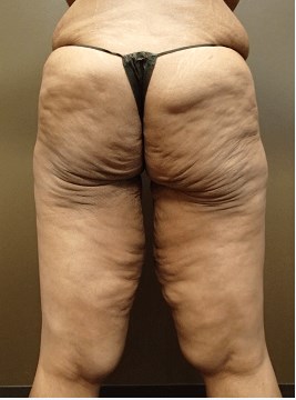 Thigh Lift with Liposuction Before