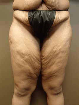 Thigh Lift with Liposuction Before