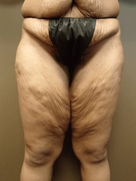 Thigh Lift with Liposuction Before