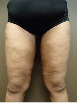 Thigh Lift with Liposuction After