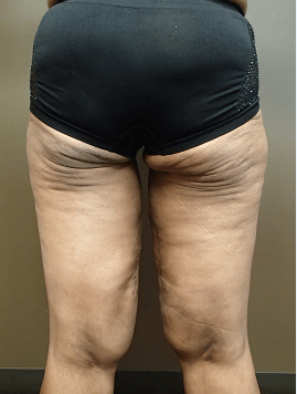 Thigh Lift with Liposuction After