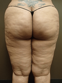 Thigh Lift with Liposuction Before