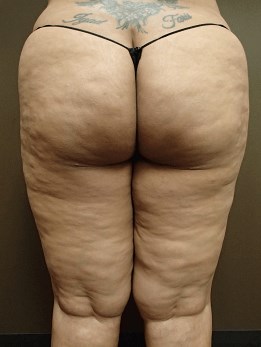 Thigh Lift with Liposuction Before