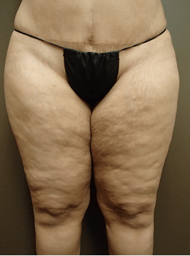 Thigh Lift with Liposuction Before