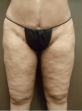 Thigh Lift with Liposuction After