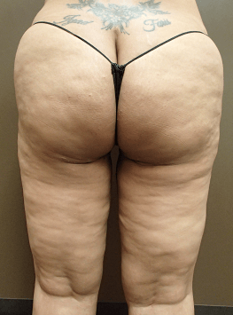 Thigh Lift with Liposuction After