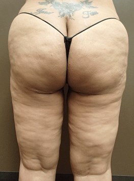 Thigh Lift with Liposuction After