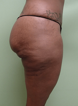 Auto Fat to Buttocks Before