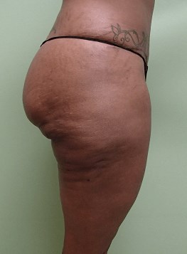 Auto Fat to Buttocks Before