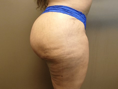 Auto Fat to Buttocks After