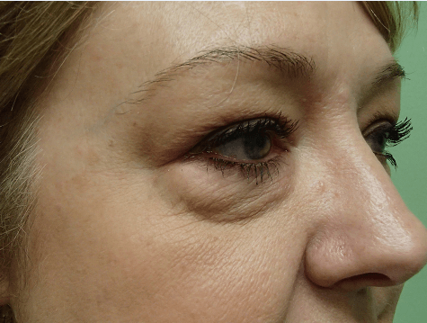 Blepharoplasty Before