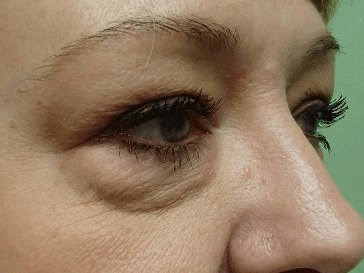 Blepharoplasty Before