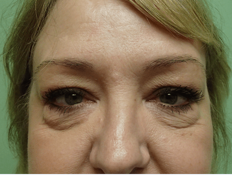 Blepharoplasty Before