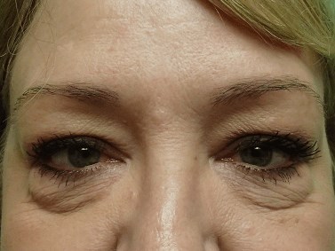 Blepharoplasty Before